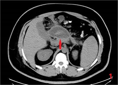 Robotic-assisted sleeve gastrectomy with simultaneous Roux-en-Y cystojejunostomy in a patient with sever obesity and a pancreatic pseudocyst: a case report